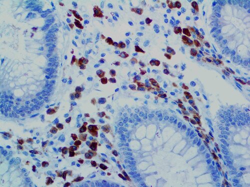 IHC of CD79a on an FFPE Colon Tissue